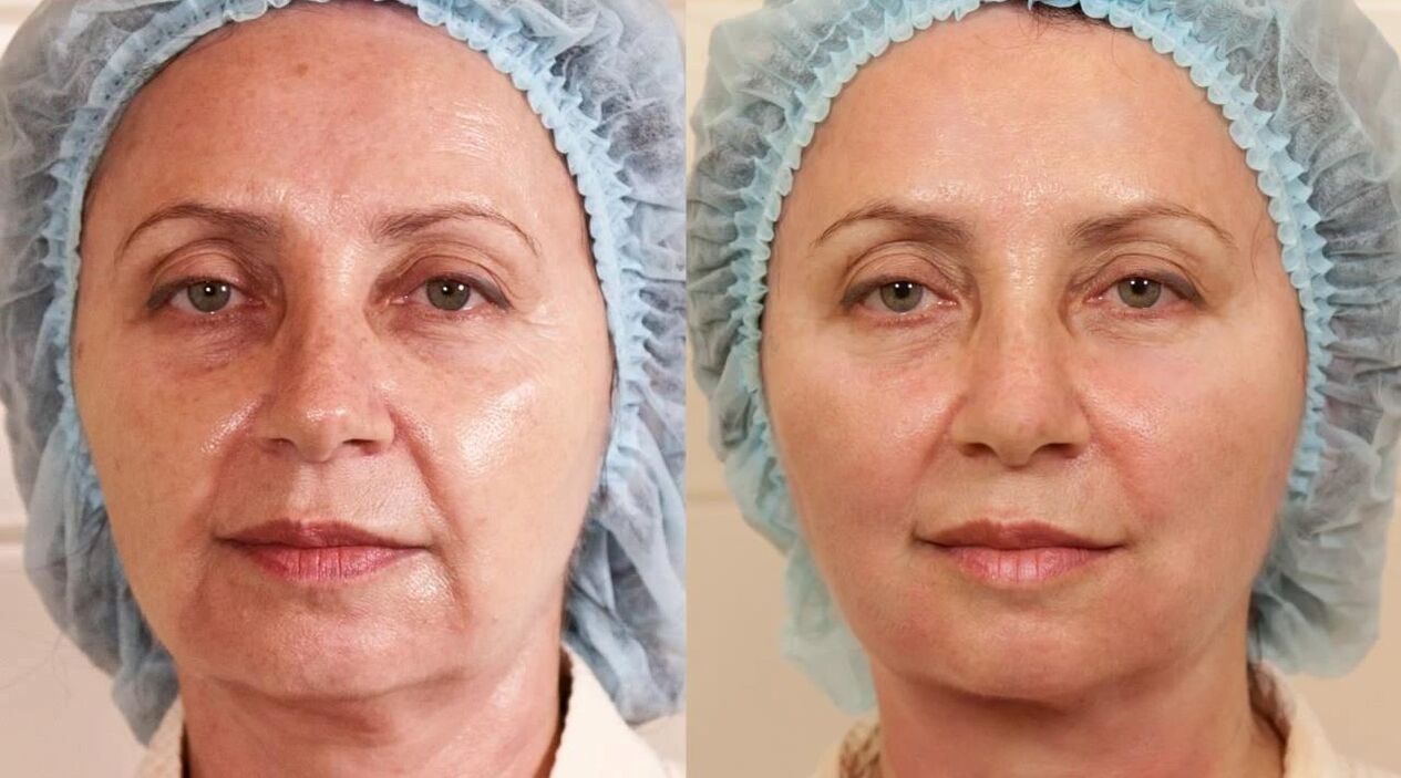 face stretch pictures before and after