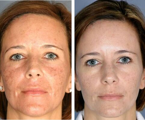 Before and after partial facial thermolysis