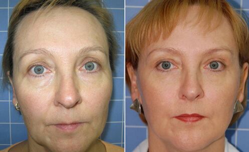 Before and after partial laser facial rejuvenation