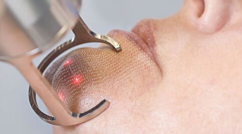 The course of the facial laser skin rejuvenation procedure